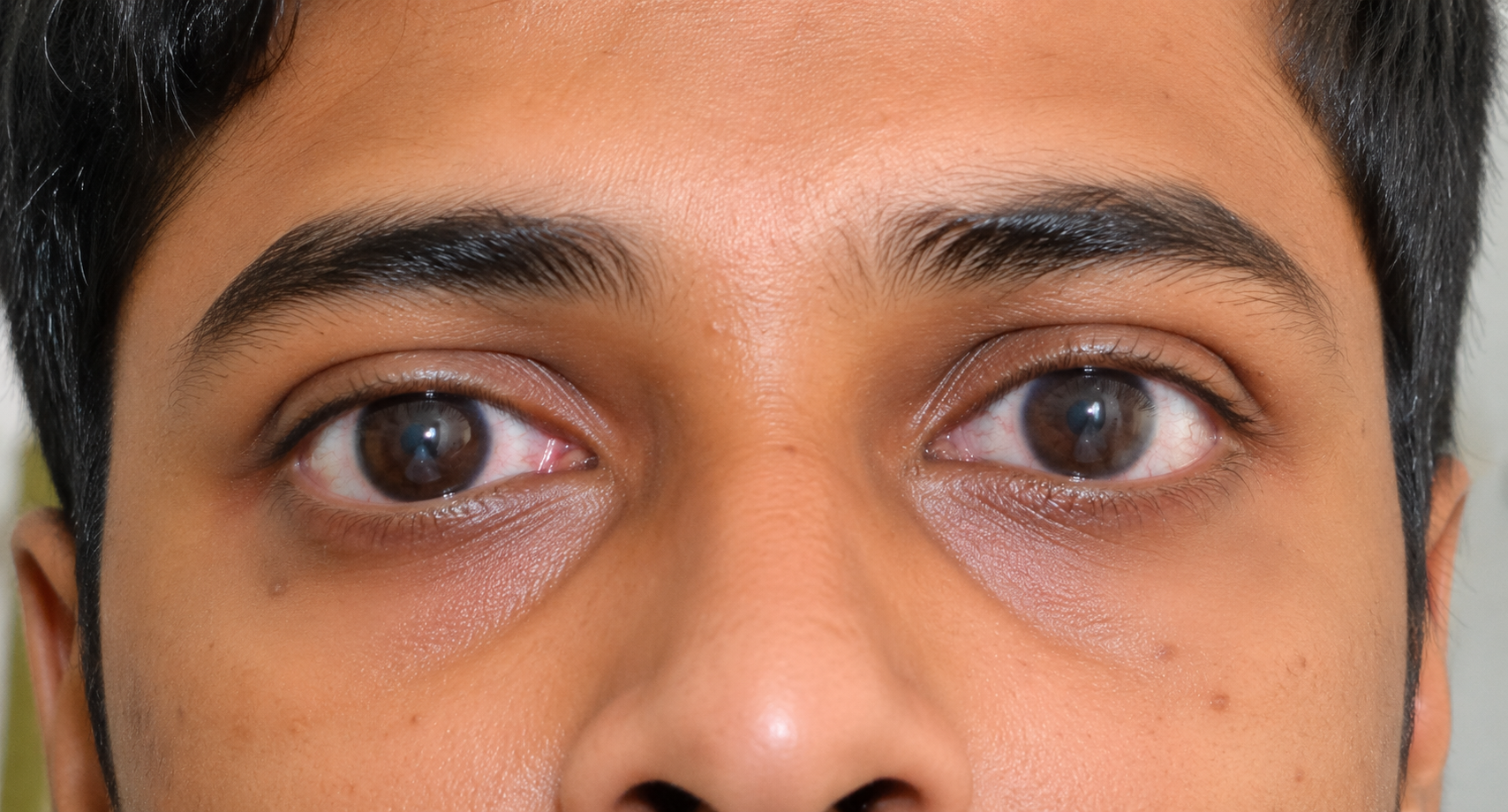 Keratoconus Treatment