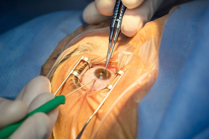 Cataract Surgery in Rohini
