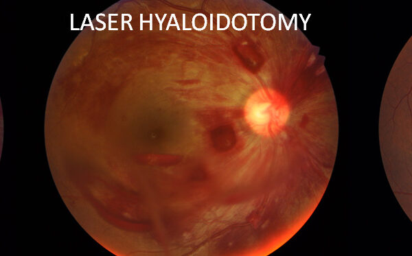 LASER-HYALOIDOTOMY