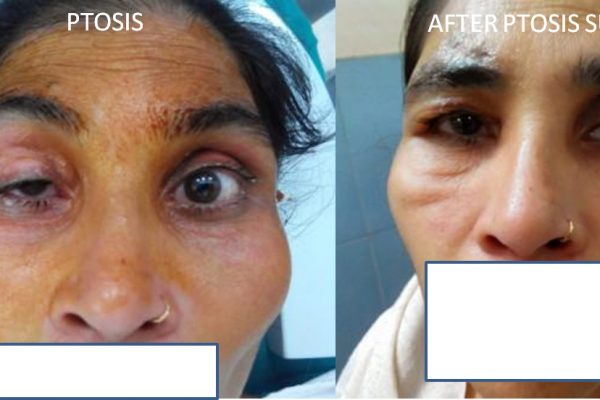 PTOSIS SURGERY