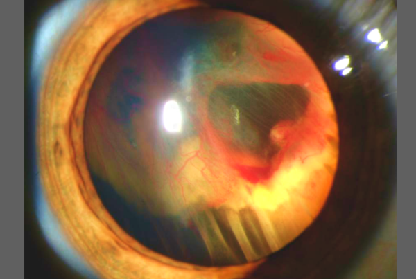 retinal detachment surgery